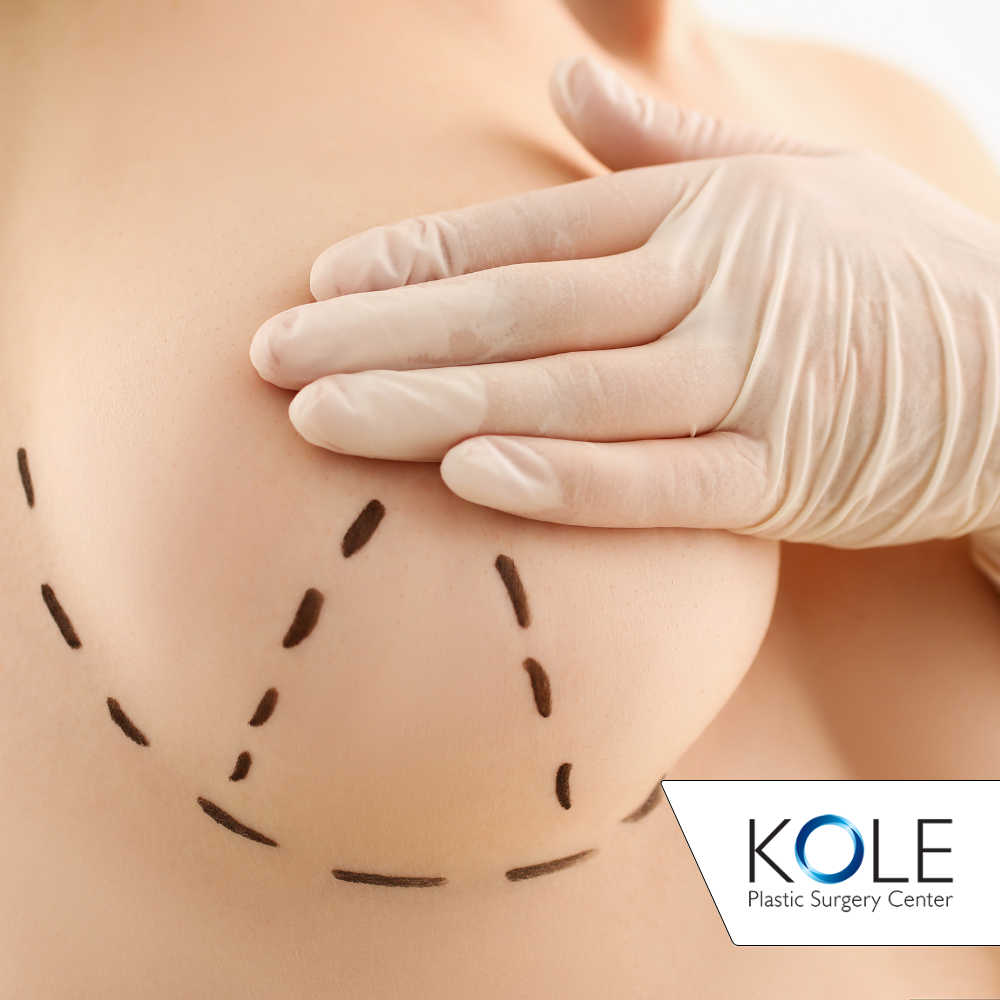 Who is Considered a Good Candidate for a Breast Lift?