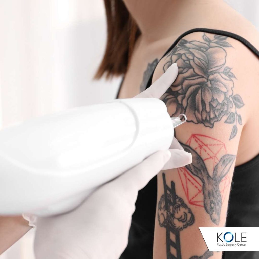 Tattoo Removal - Kole Plastic Surgery Bucks County