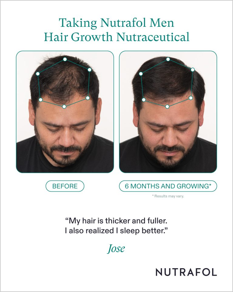 Nutrafol_126279_Pro_Before_After_Photos_Ad_Templates
Before and After